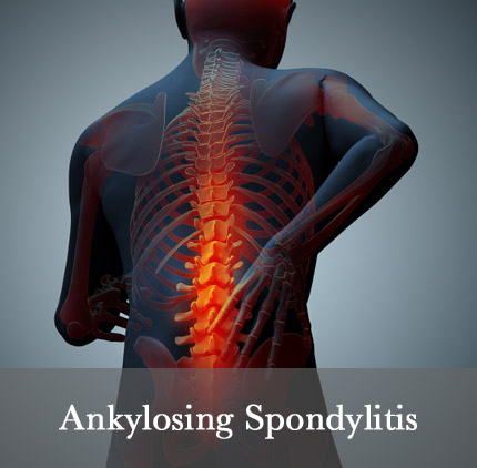Back pain Ankylosing Spondylitis